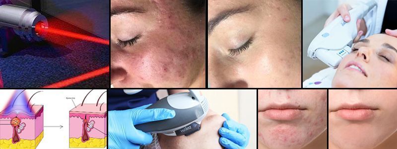 OFERTA DE ESTÉTICA EN PALMA PARA TRATAMIENTO LÁSER ACNÉ MALLORCA