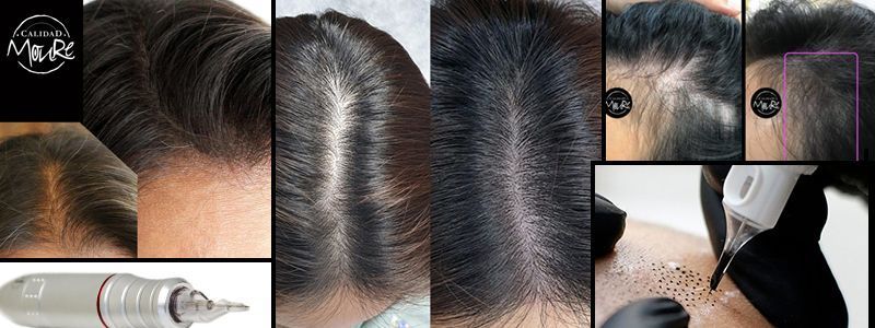 OFERTA DE MICROPIGMENTACIÓN CAPILAR MUJER