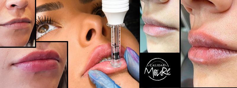 OFERTA DE ESTÉTICA MALLORCA EN ÁCIDO HIALURÓNICO LABIOS