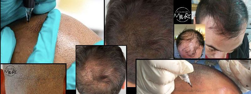 DESCUENTO DE MICROPIGMENTACIÓN CAPILAR MALLORCA