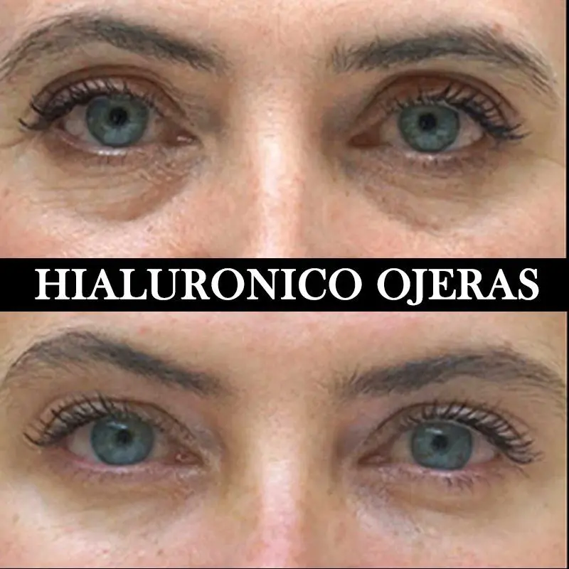 ACIDO HIALURONICO ENTRECEJO NASOJENIANO, OJOS CENTROS MOURE MALLORCA (1)