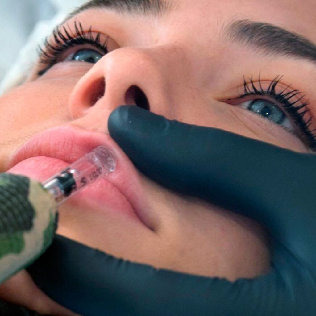 ACIDO HIALURONICO LABIOS, HIALUROPEN PALMA DE MALLORCA CENTROS MOURE (8)