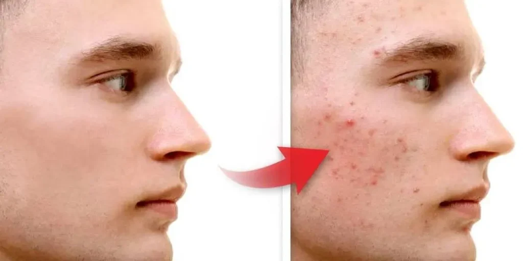 ACNE EN LA CARA ANTES Y DESPUES (11)