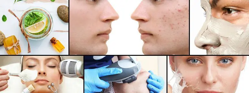 BANNER-TRATAMIENTO-DE-ACNE-CENTROS-DE-ESTETICA-MOURE-PALMA-DE-MALLORCA