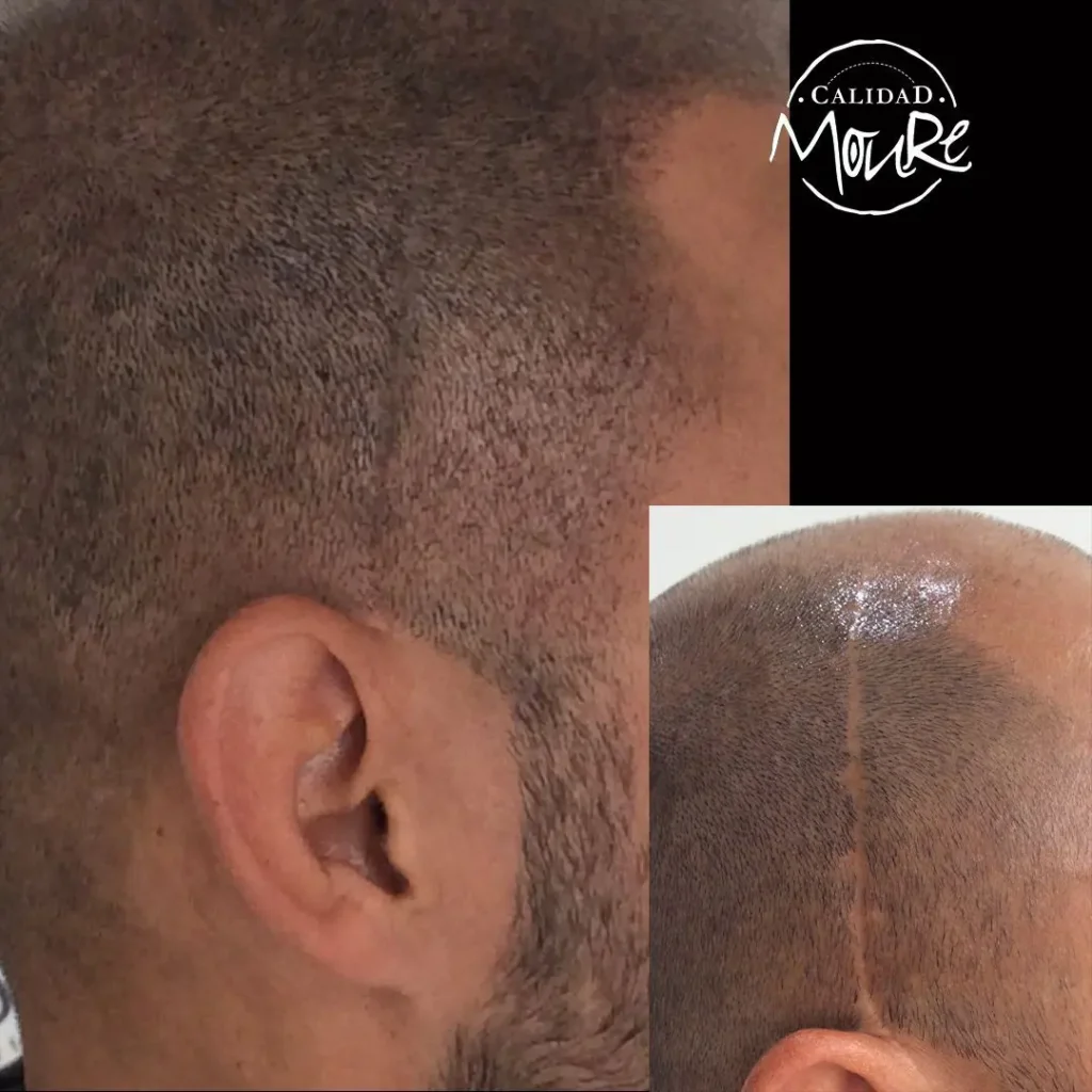 MICROPIGMENTACION CAPILAR CICATRICES MOURE (5)