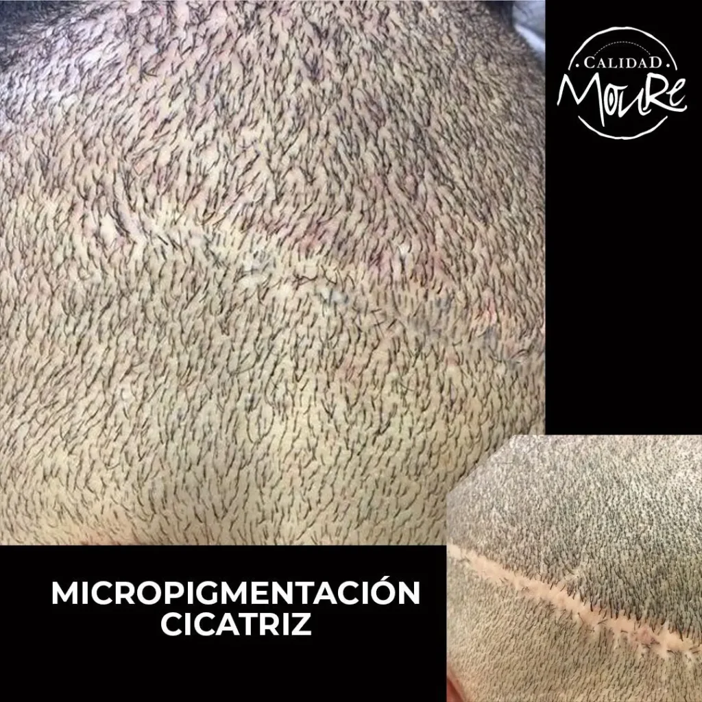 MICROPIGMENTACION CAPILAR CICATRICES MOURE (6)