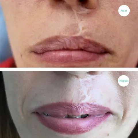 Micropigmentacion Correccion De Labio Con Cicatriz 480X480 Jpg