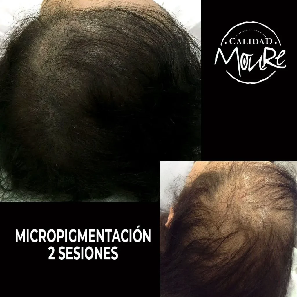 MICROPIGMENTACION MUJER MOURE MAS DENSIDAD PELO LARGO (15)