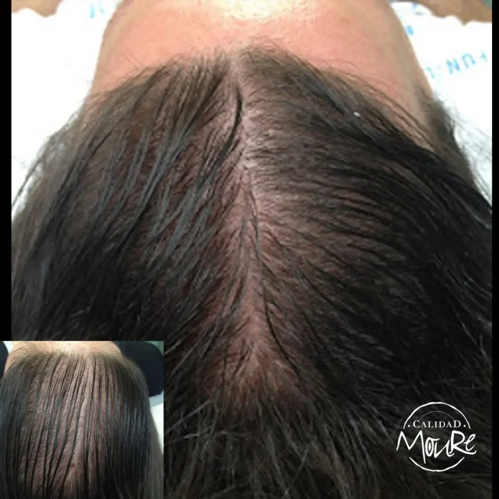 MICROPIGMENTACION MUJER MOURE MAS DENSIDAD PELO LARGO (3)