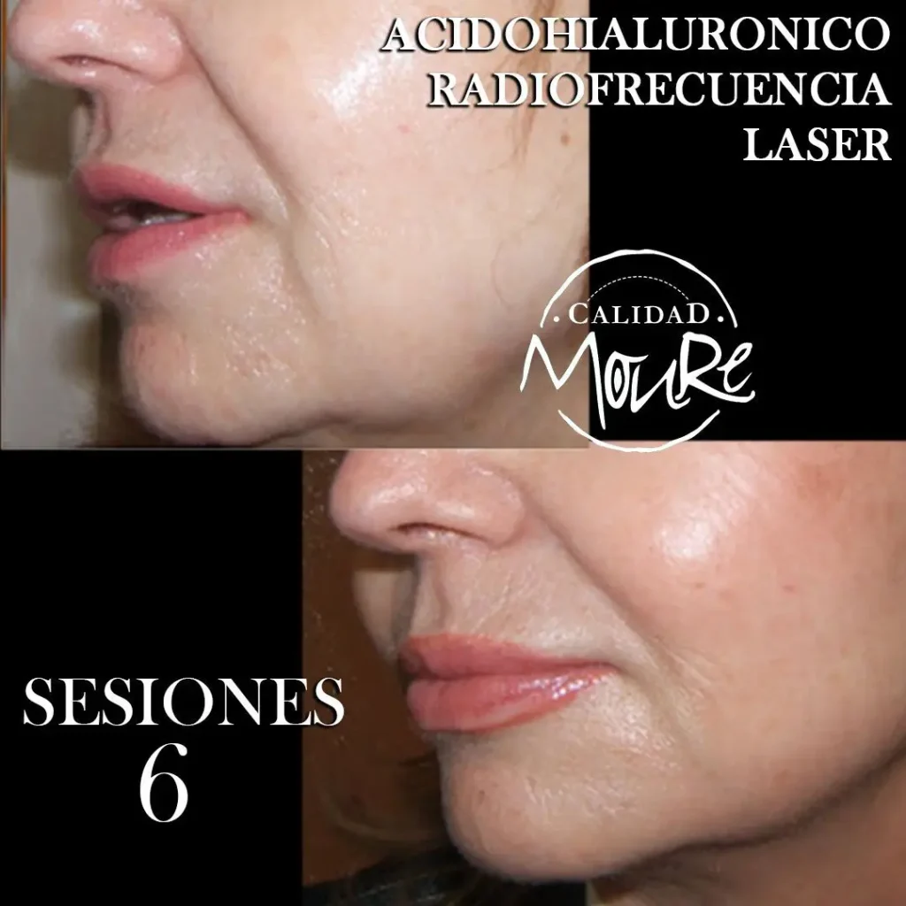 RADIOFRECUENCIA LASER GALVANICA Y ACIDO HIALURONICO CENTRO DE ESTETICA MOURE MALLORCA (11)