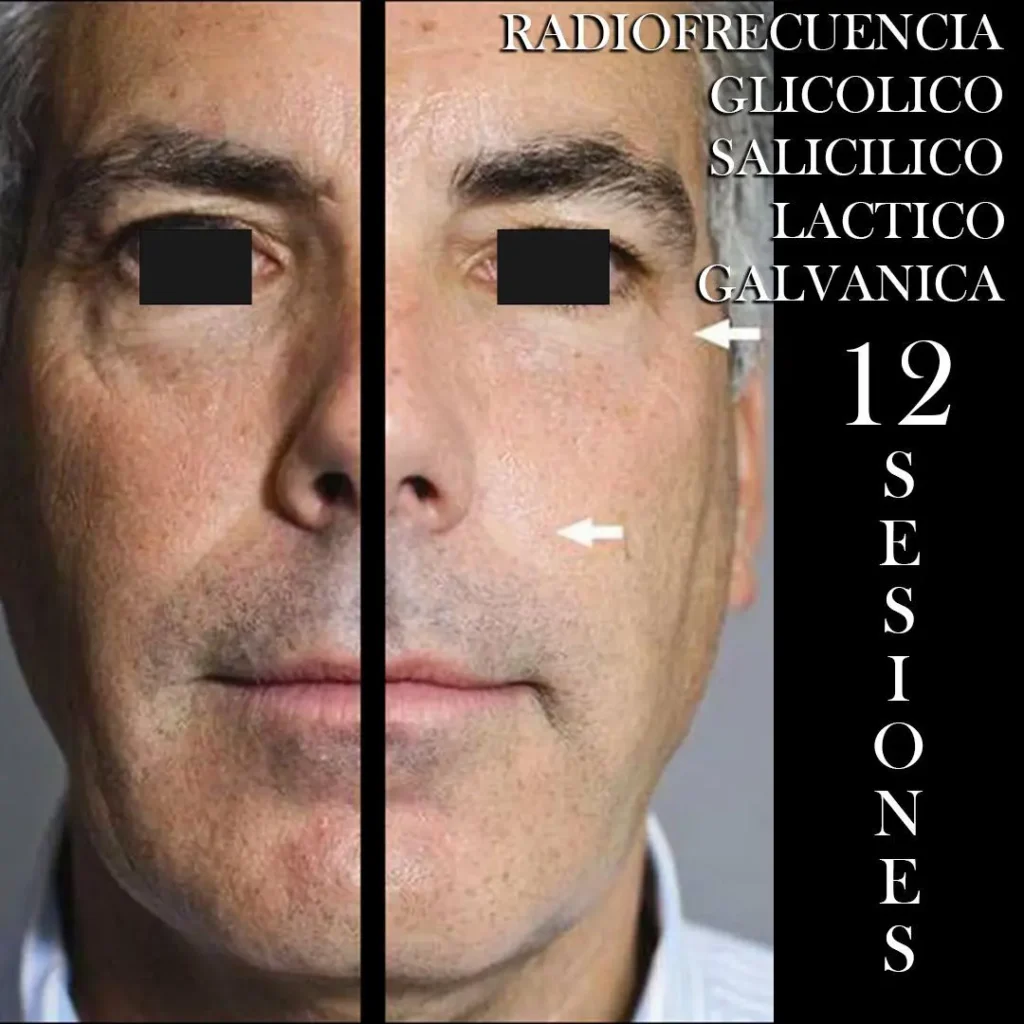 RADIOFRECUENCIA LASER GALVANICA Y ACIDO HIALURONICO CENTRO DE ESTETICA MOURE MALLORCA (3)
