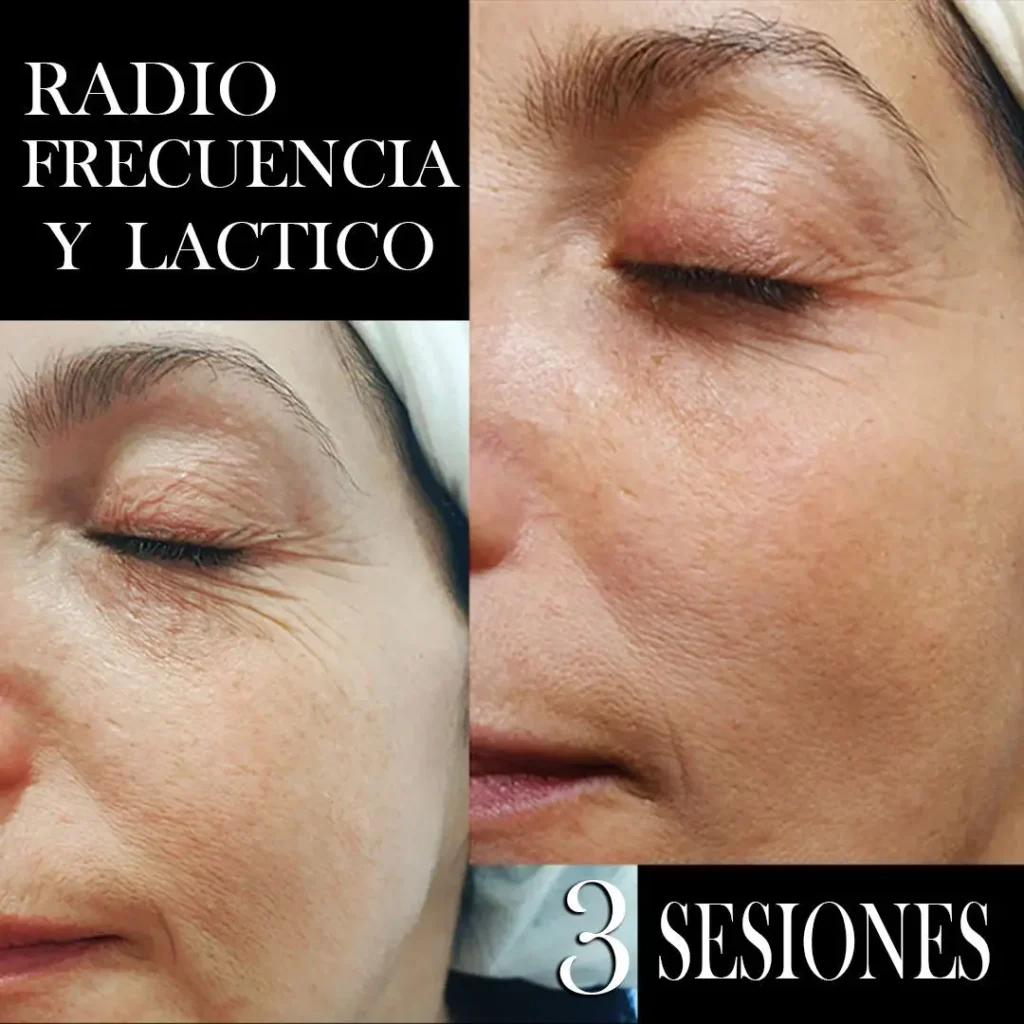 RADIOFRECUENCIA LASER GALVANICA Y ACIDO HIALURONICO CENTRO DE ESTETICA MOURE MALLORCA (5)