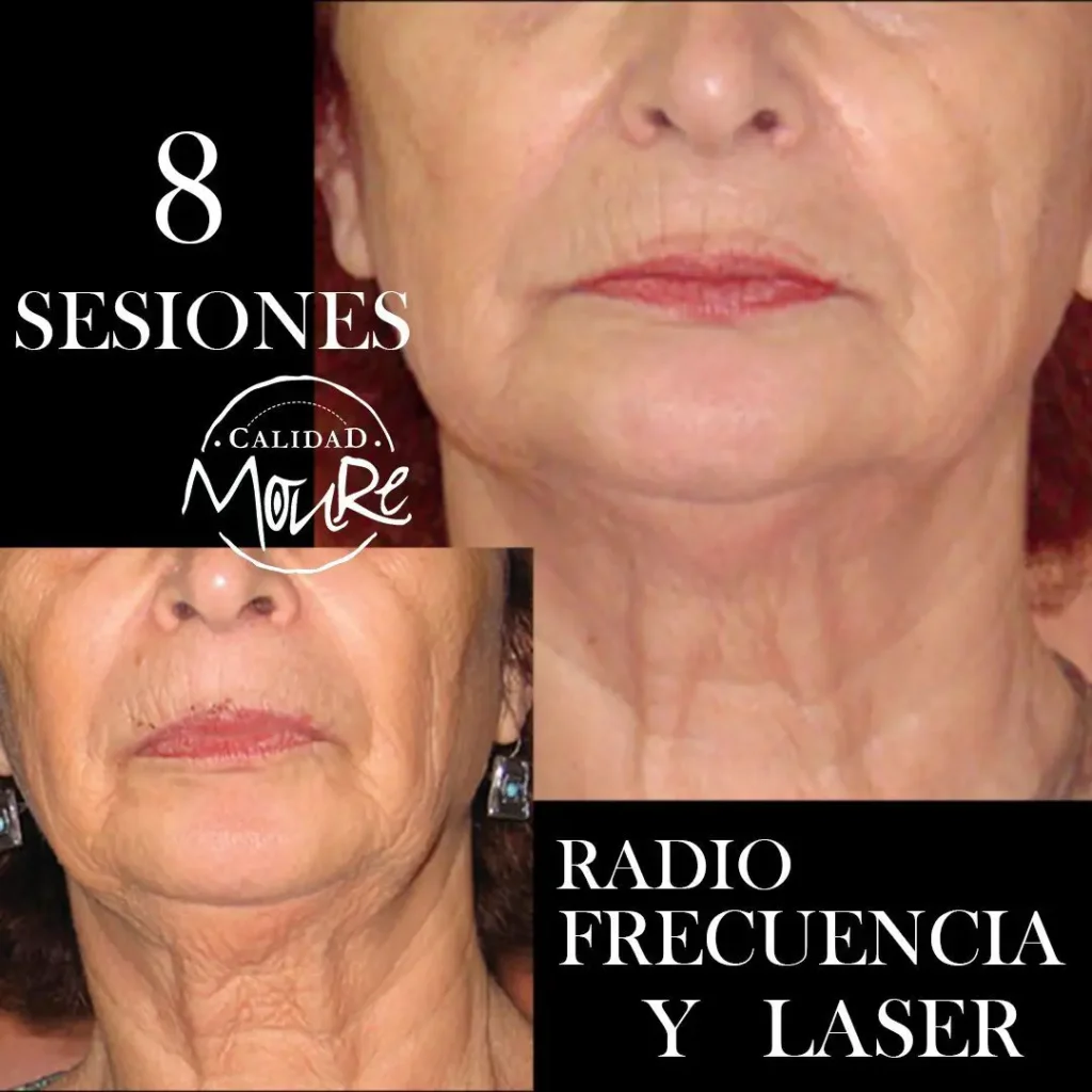 RADIOFRECUENCIA LASER GALVANICA Y ACIDO HIALURONICO CENTRO DE ESTETICA MOURE MALLORCA (6)