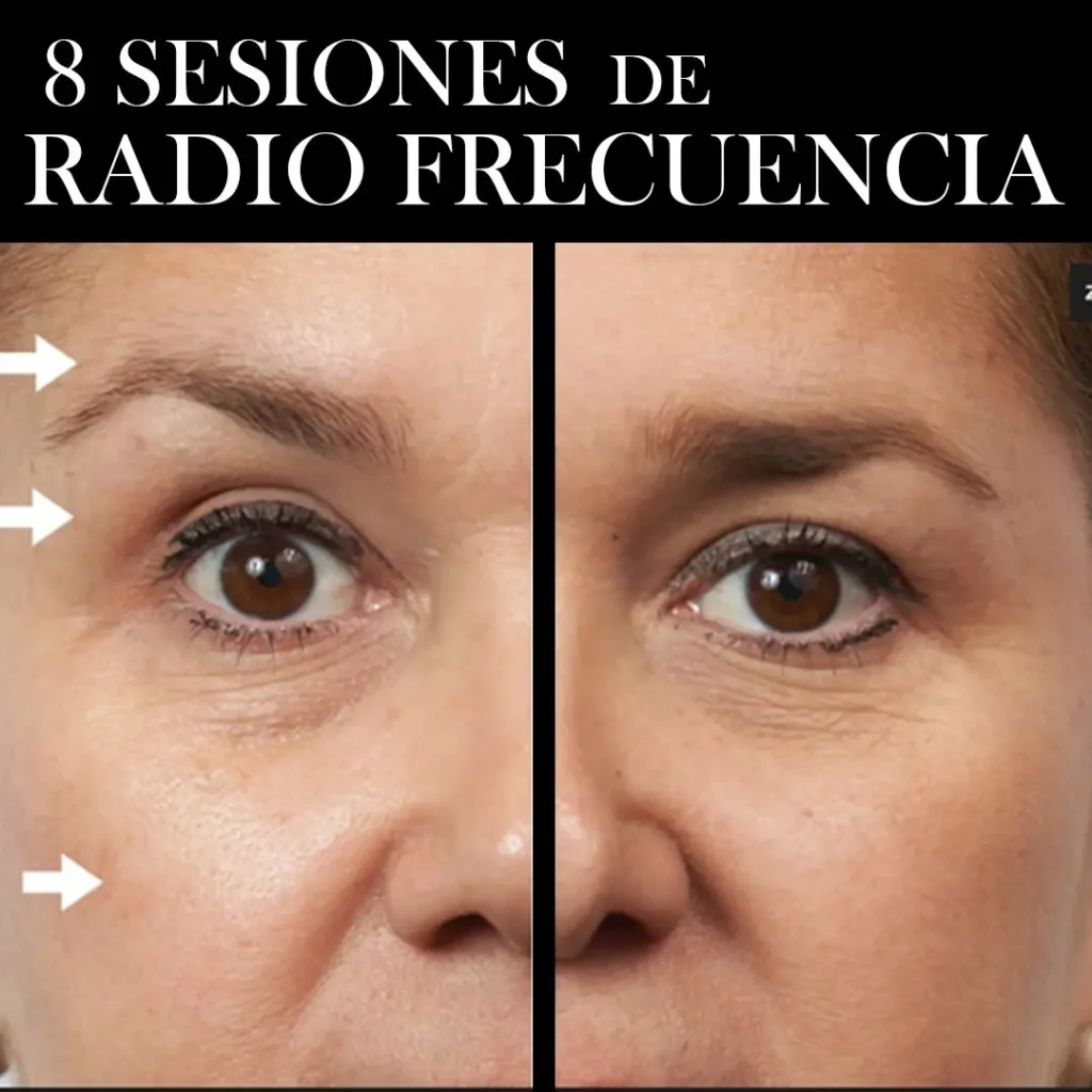 RADIOFRECUENCIA LASER GALVANICA Y ACIDO HIALURONICO CENTRO DE ESTETICA MOURE MALLORCA (8)
