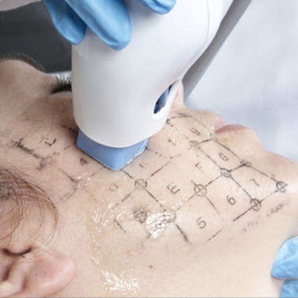 RADIOFRECUENCIA LASER GALVANICA Y ACIDO HIALURONICO CENTRO DE ESTETICA MOURE MALLORCA (1)