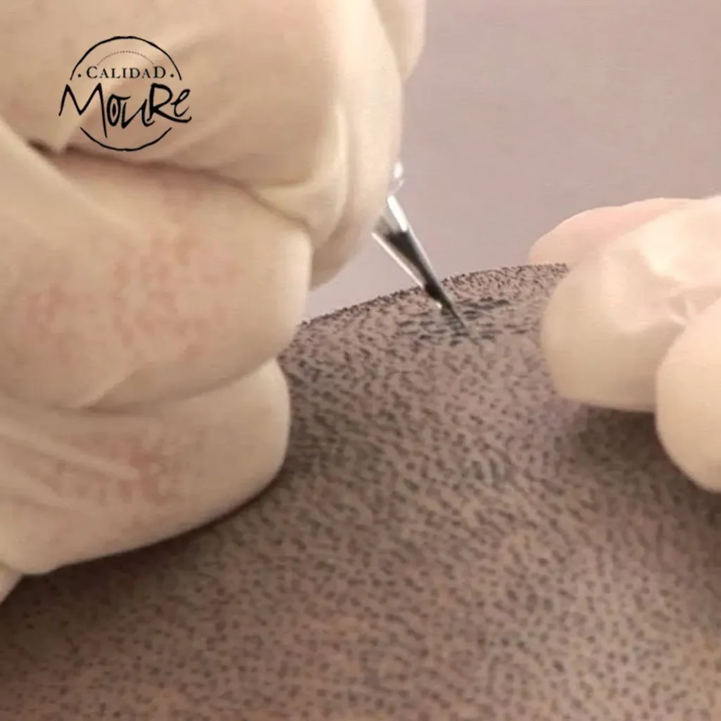 TECNICA DE REALIZACION DE MICROPIGMENTACION CAPILAR (5)