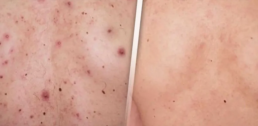 TRATAMIENTO DE ACNE EN LA ESPALDA MALLORCA CENTROS MOURE (17)