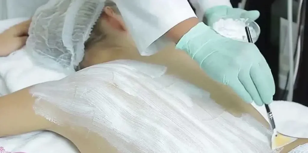 TRATAMIENTO DE ACNE EN LA ESPALDA MALLORCA CENTROS MOURE (1)