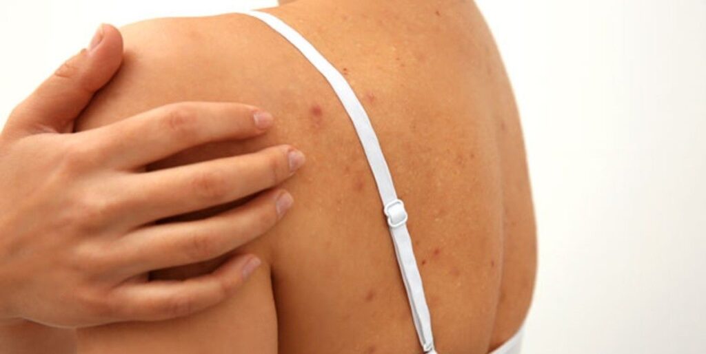 TRATAMIENTO DE ACNE EN LA ESPALDA MALLORCA CENTROS MOURE (9)