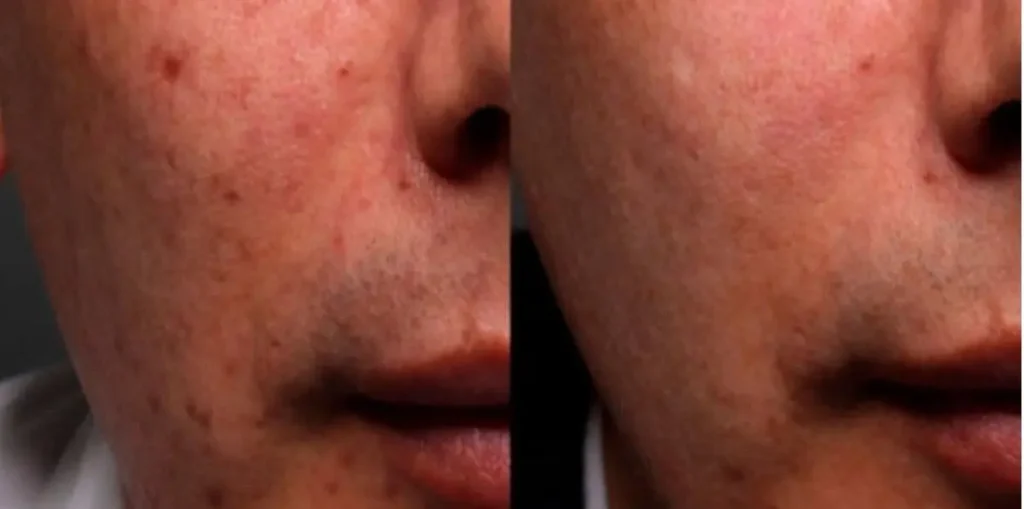 TRATAMIENTO PARA QUITAR MARCAS DE ACNE (1)