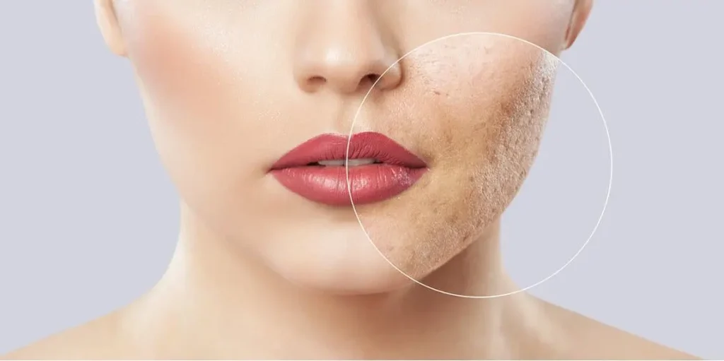 TRATAMIENTO PARA QUITAR MARCAS DE ACNE (2)