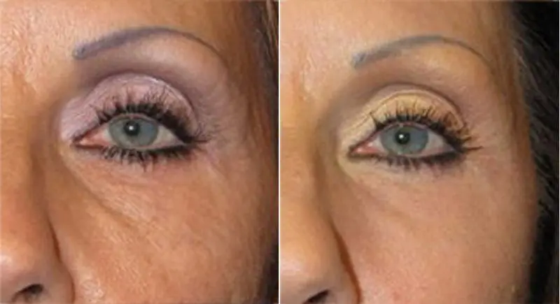 Antes y despues de hialuronico radiofreciencia, acidos y mesoterapia (3)