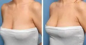 Antes y despues tratamiento de pecho (2)