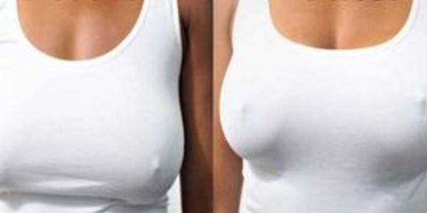 Antes y despues tratamiento de pecho (4)