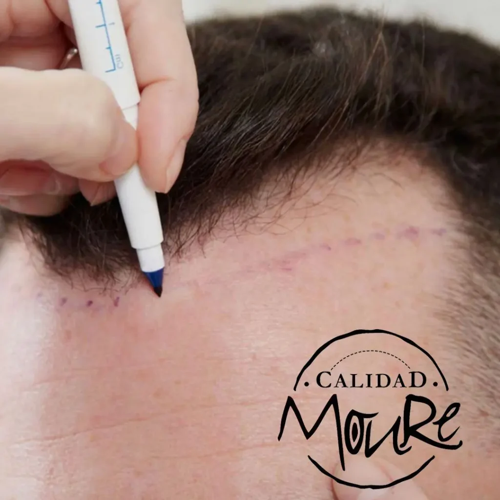 Micropigmentación capilar hombre relleno pelo largo (6)