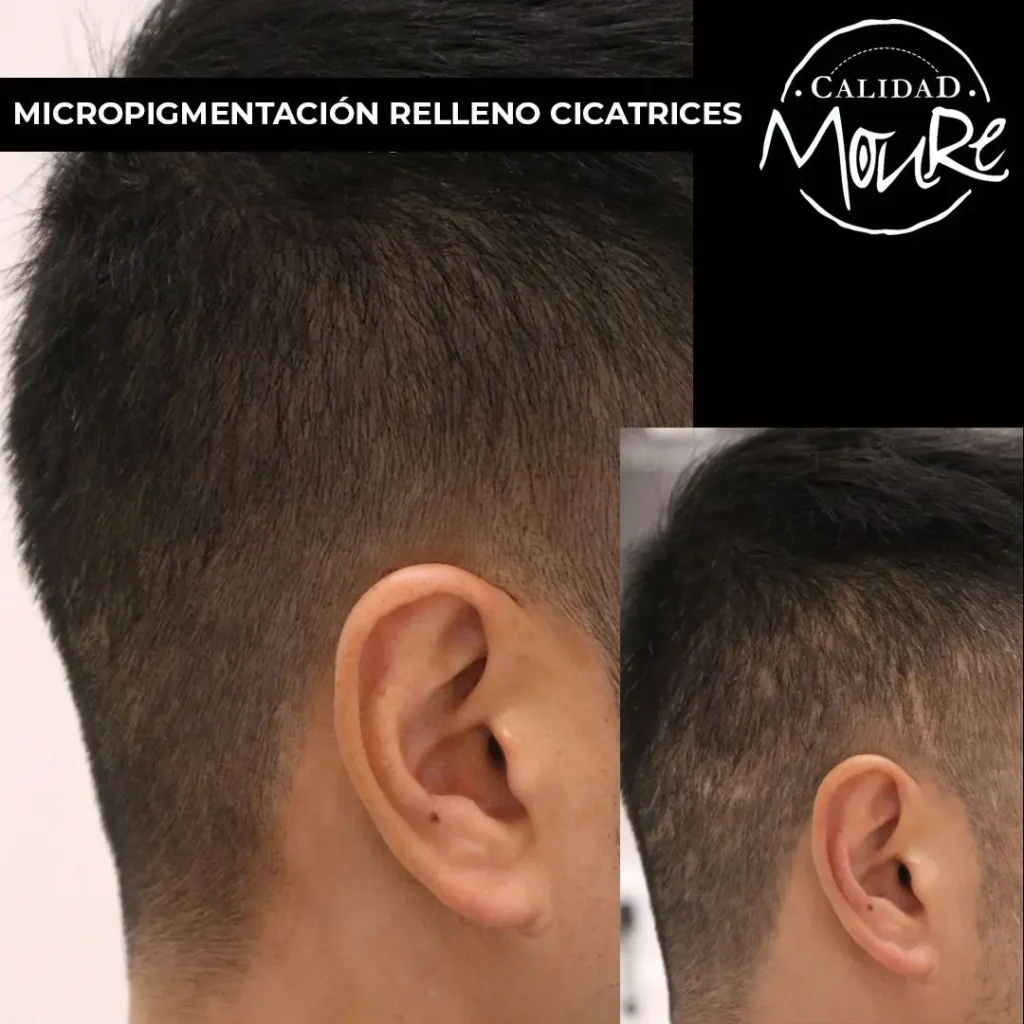 Micropigmentación capilar hombre relleno pelo largo (7)