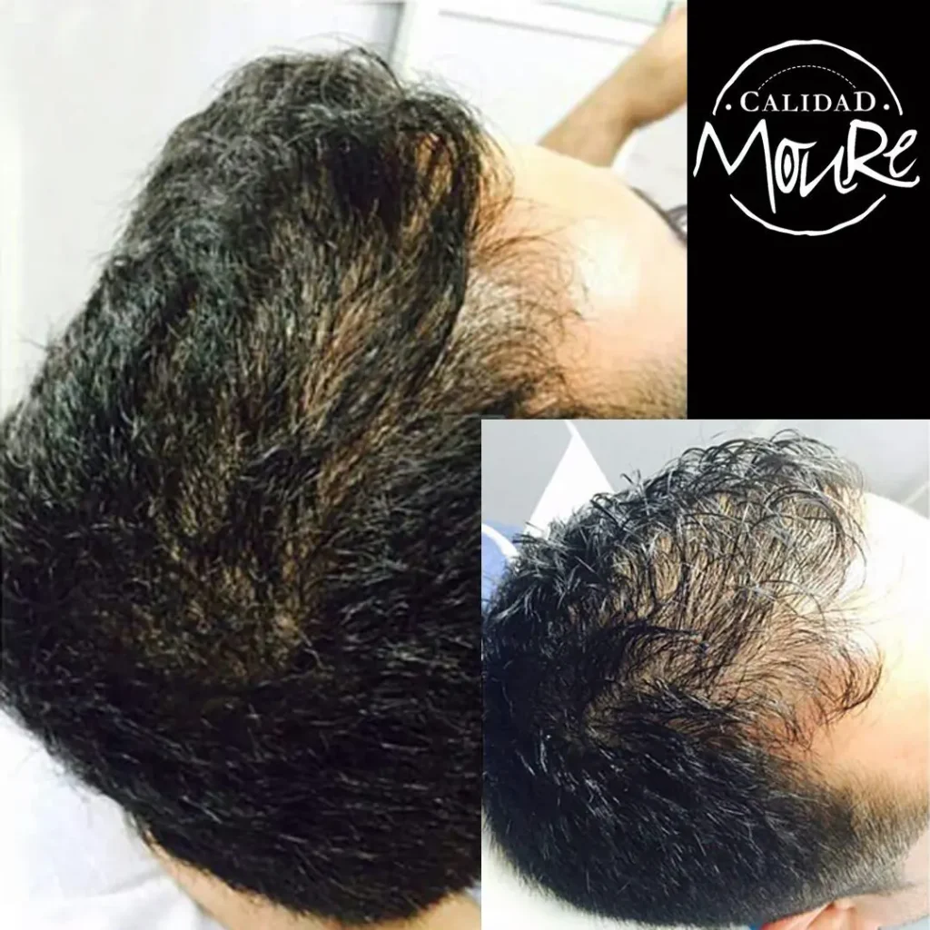 Micropigmentación capilar hombre relleno pelo largo (8)