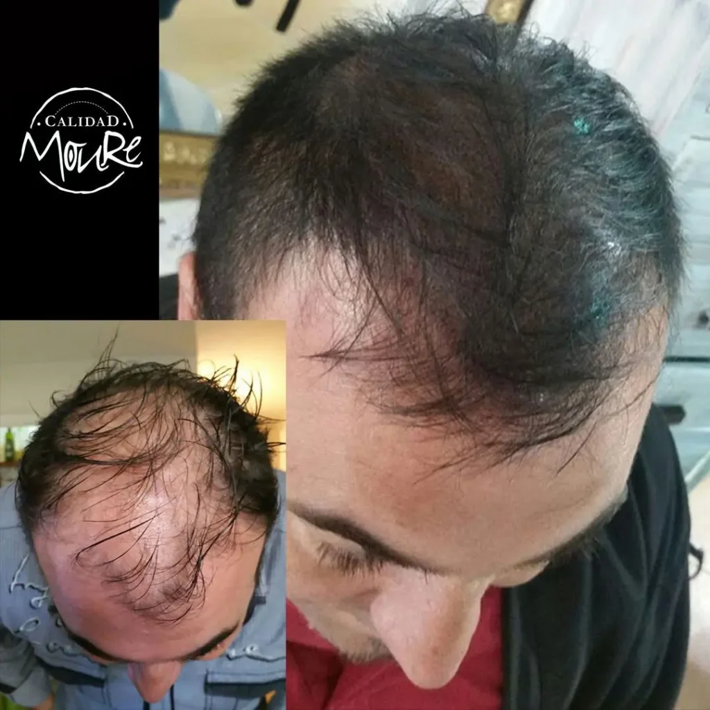 MICROPIGMENTACION HOMBRE CABELLO LARGO