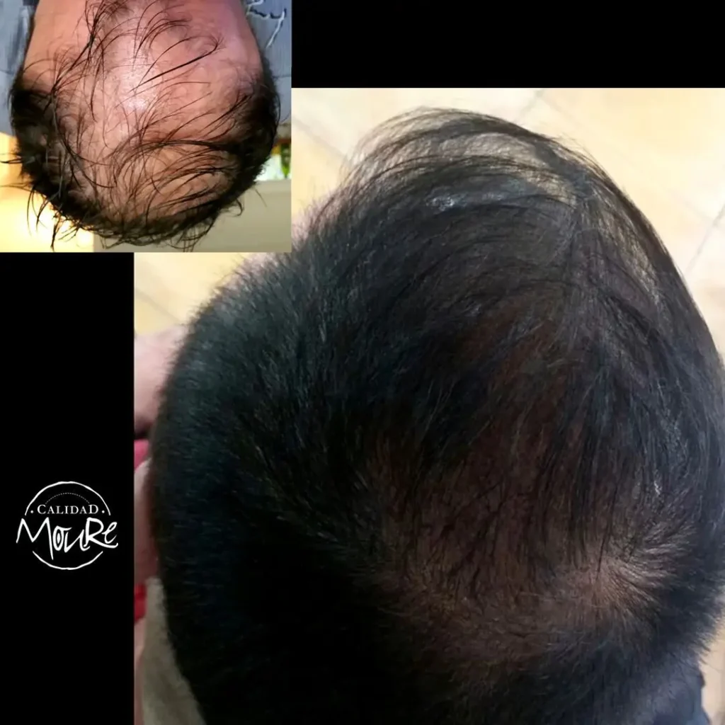 MICROPIGMENTACION CAPILAR PELO LARGO